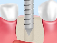 インプラント