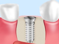 インプラント
