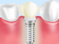 インプラント