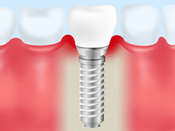 インプラント周囲粘膜炎