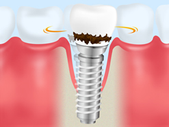 インプラント周囲炎
