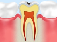 虫歯のメカニズム