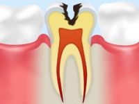 虫歯のメカニズム