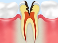 虫歯のメカニズム