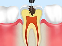 エナメル質と象牙質の除去